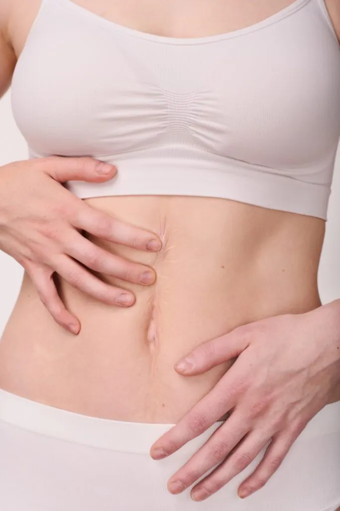 Person touching a surgical scar on their abdomen after plastic surgery.