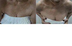 Before and after breast augmentation transformation image.