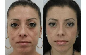 Before and after results of facial rejuvenation treatment on a woman.