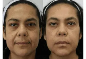 Before and after comparison of facial rejuvenation procedure with visible skin improvements.