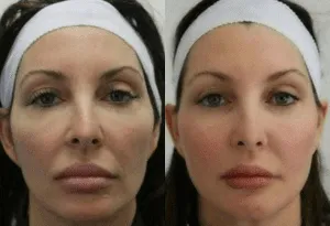 Before and after results of facial plastic surgery treatment on a woman.