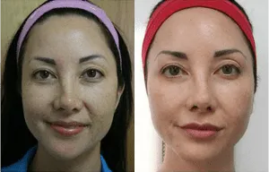 Before and after images of a woman's facial transformation at a plastic surgery center.