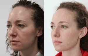 Before and after profile images of a woman showcasing results from facial plastic surgery.