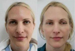 Before and after facial rejuvenation surgery showcasing improved skin appearance.