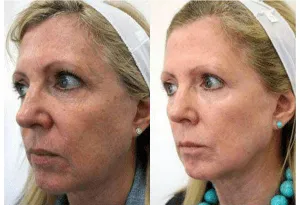 Before and after results of a woman's facial cosmetic procedure showing improved skin appearance.