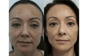 Before and after image of a woman's face post-cosmetic procedure showing smoother skin and enhanced facial features.