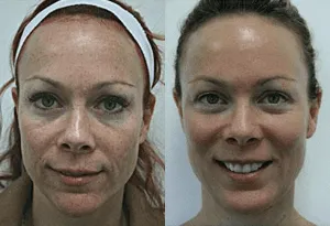 Before and after photos of a woman's facial rejuvenation procedure at a plastic surgery center.