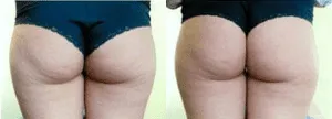 Before and after cellulite reduction treatment on thighs.