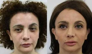 Before and after images showcasing facial rejuvenation results at a plastic surgery center.