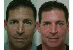 Before and after photos of a man showcasing plastic surgery results with improved facial appearance.