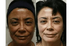 Before and after facelift comparison on a woman's face.