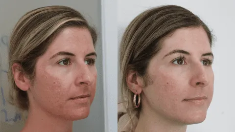 Before and after images of a woman's facial skin treatment.
