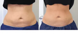 Before and after photos of a person's torso showing results of a cosmetic procedure.