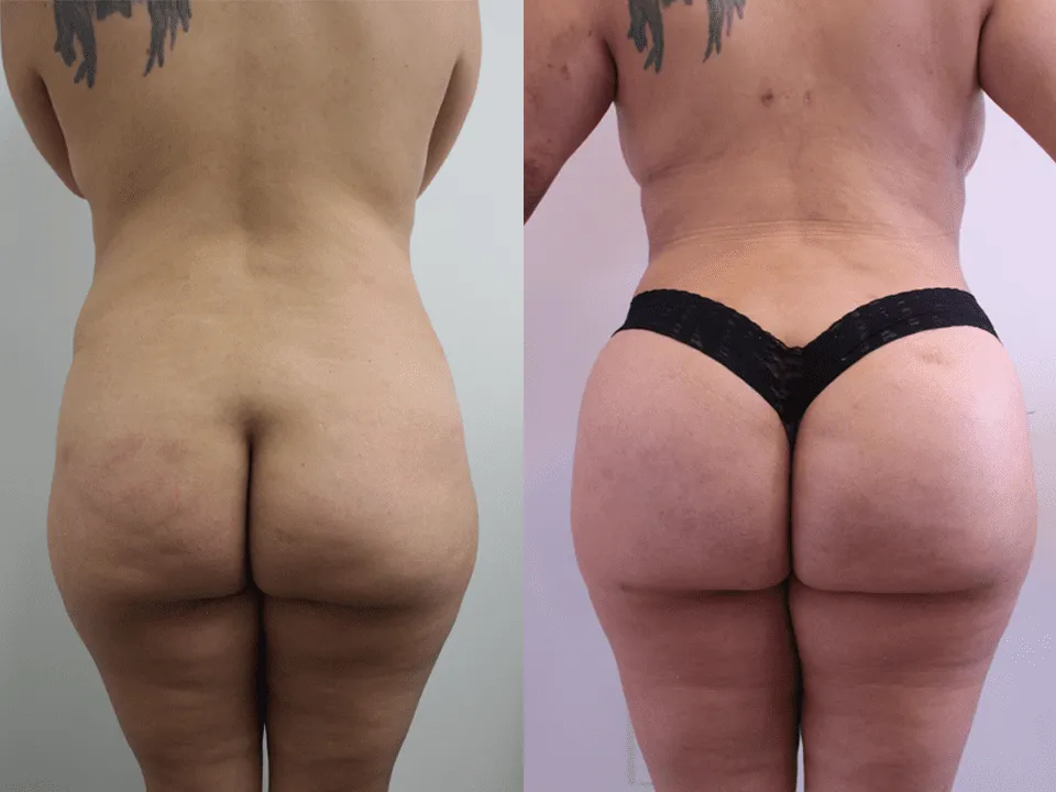 Before and after photos showing results of a buttock enhancement procedure.