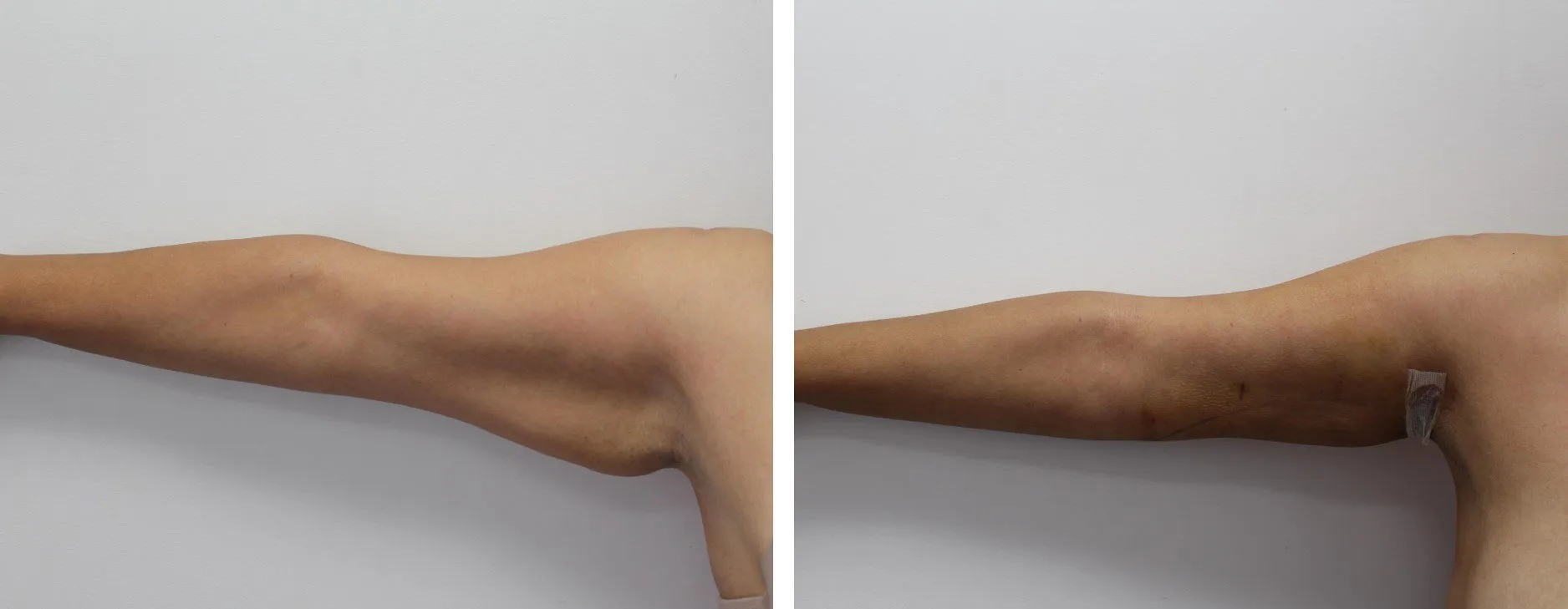 Before and after arm lift surgery showing reduced sagging skin.