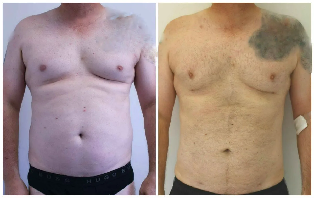Before and after male chest contouring surgery at a Plastic Surgery Center.