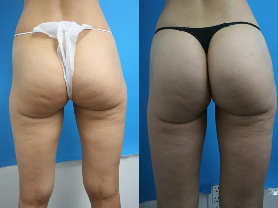 Before and after images of a female patient showcasing results of a buttock augmentation procedure.