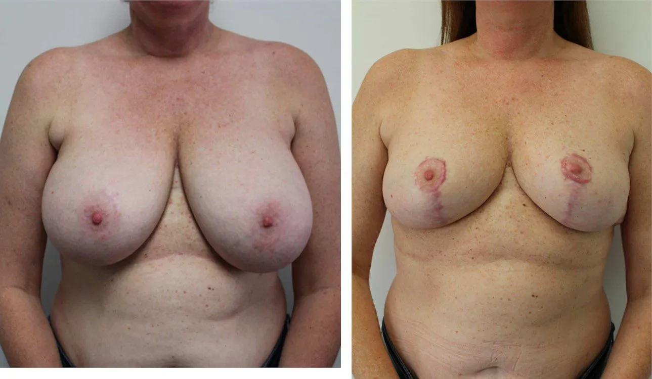 Before and after comparison of breast reduction surgery results.