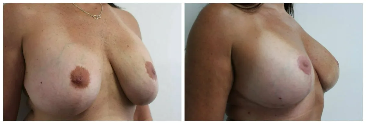 Before and after image of breast lift surgery showing improved symmetry and contour.