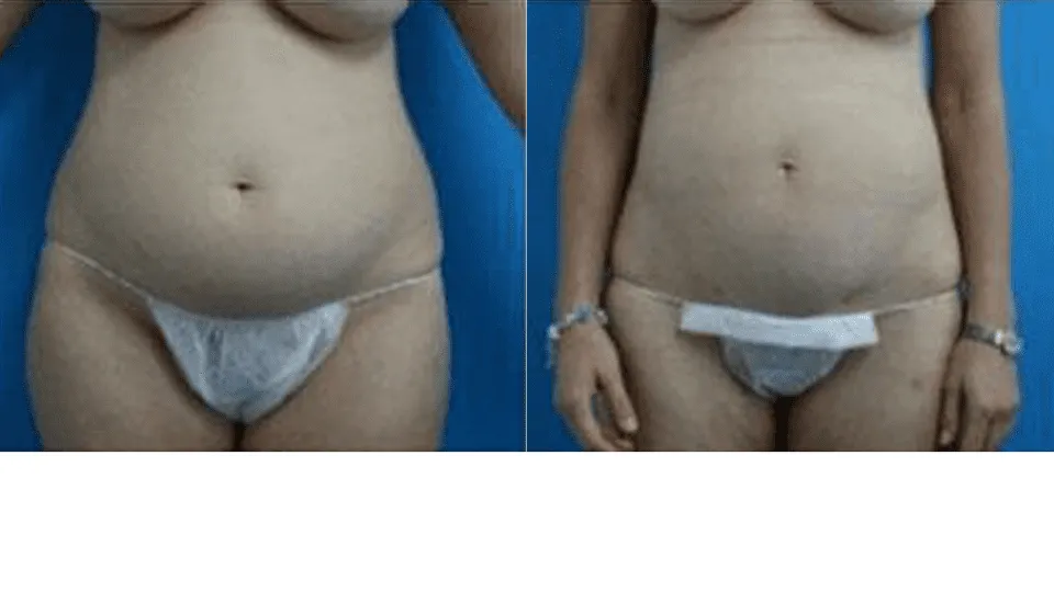Before and after image of a woman's abdomen showing liposuction results.