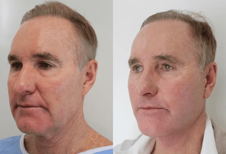 Before and after photos of a man's facial enhancements at a plastic surgery center.