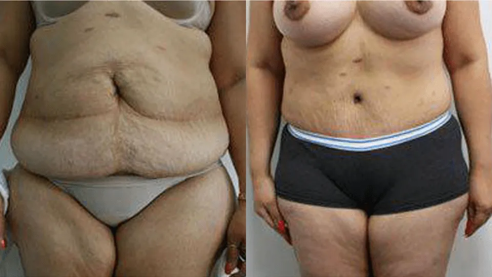 Before and after images of a woman's midsection following a tummy tuck procedure.