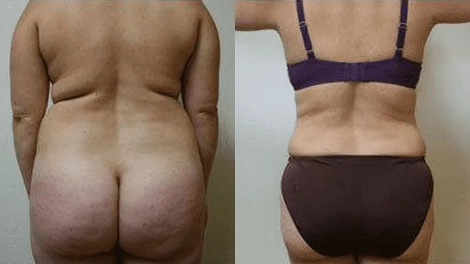 Before and after image of a woman's back showcasing body contouring results.