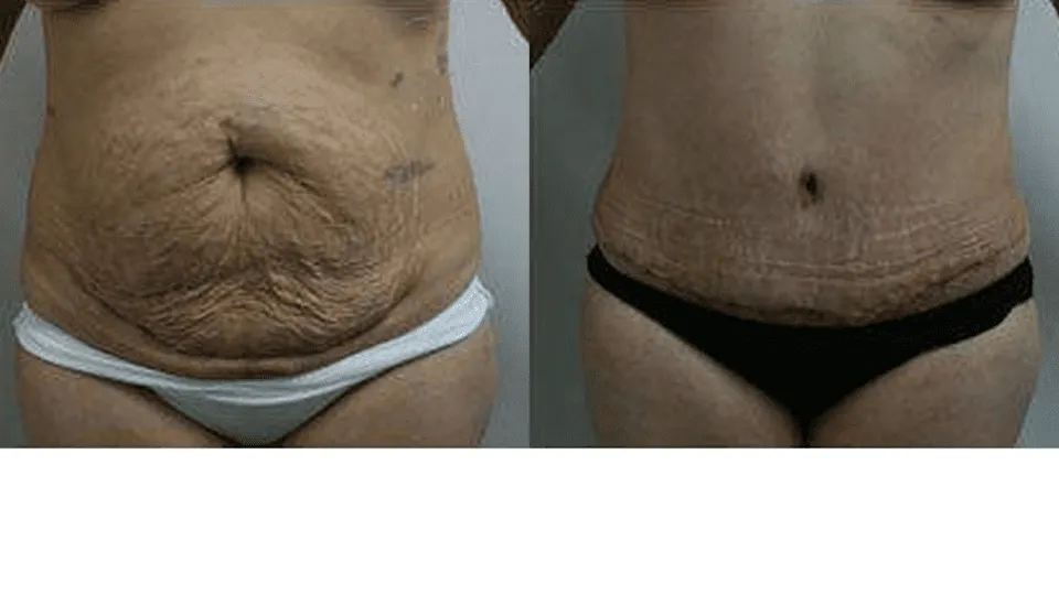 Before and after image of a tummy tuck surgery showing significant abdominal improvement.