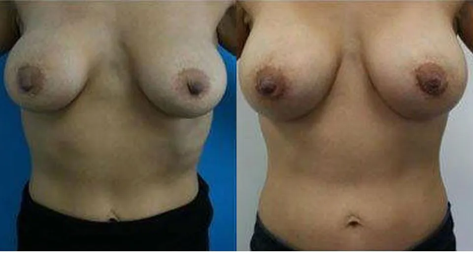 Before and after image of breast augmentation surgery showing enhanced size and symmetry.