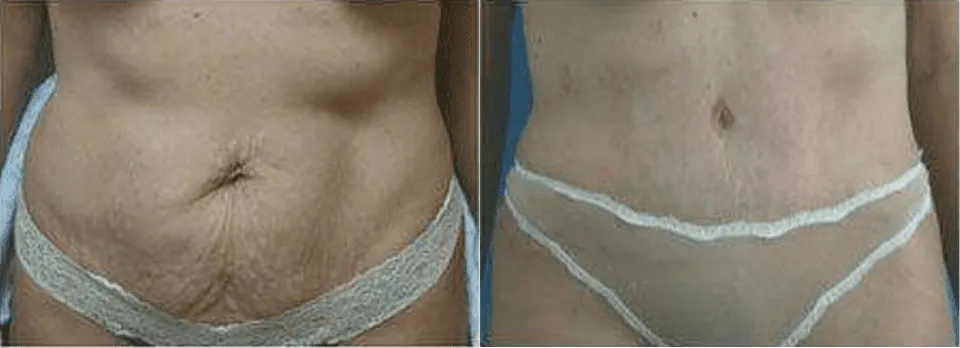 Before and after tummy tuck results showing improved abdominal contour.