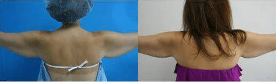 "Before and after arm lift surgery results showing improved arm contour."