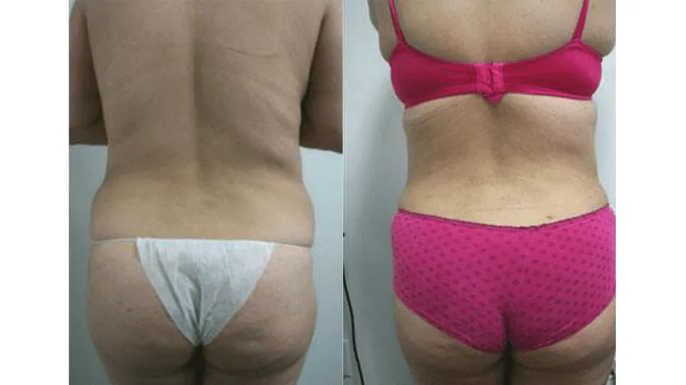 Before and after image showing back view results of female body contouring surgery.