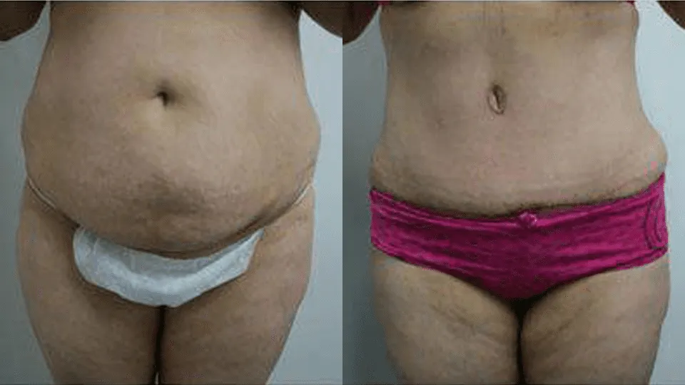Before and after image showing results of abdominal plastic surgery procedure.