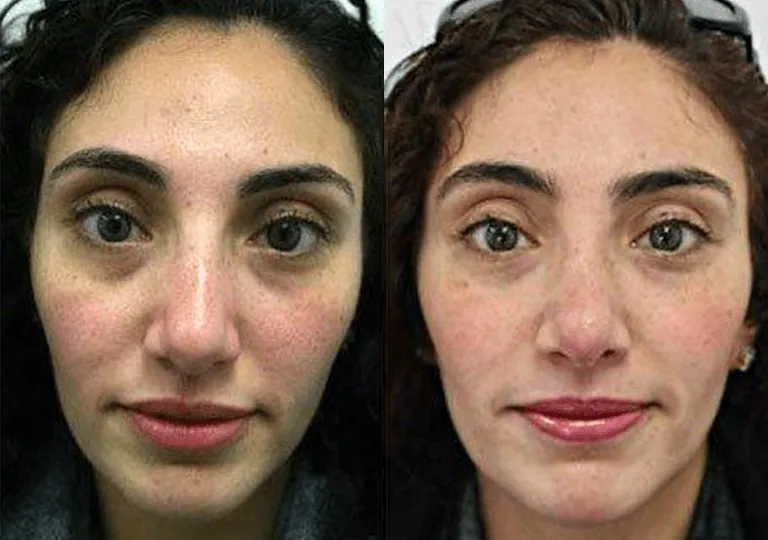 Before and after image of a woman's face showcasing results of a cosmetic procedure.