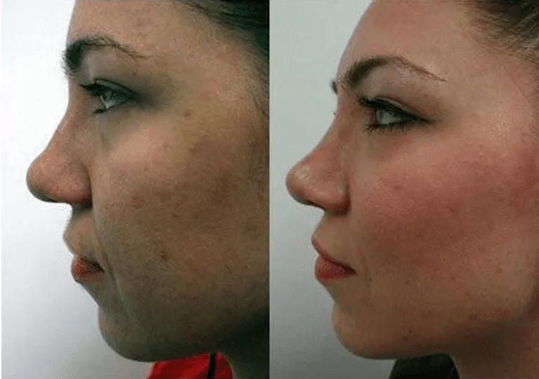 Before and after rhinoplasty side profile comparison of a woman's nose.