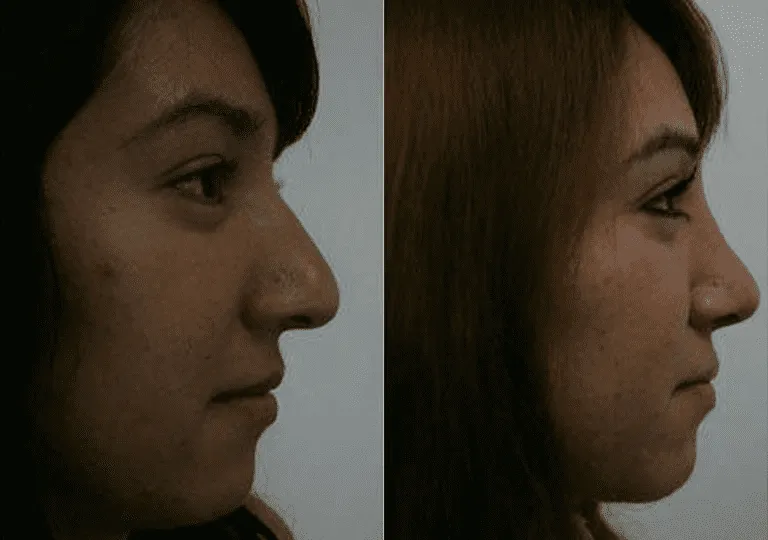 Before and after side profile of a woman's nose demonstrating rhinoplasty results.