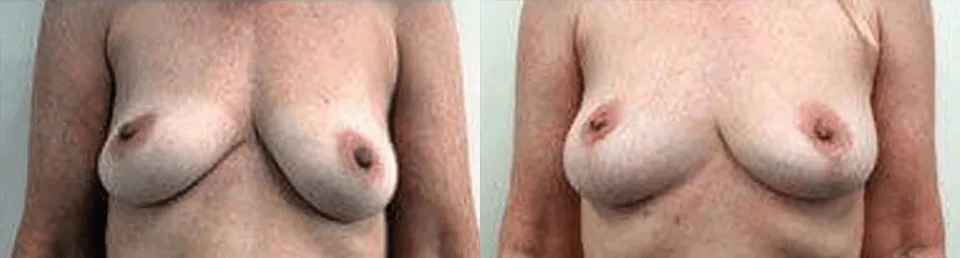 Before and after breast augmentation results on a woman.