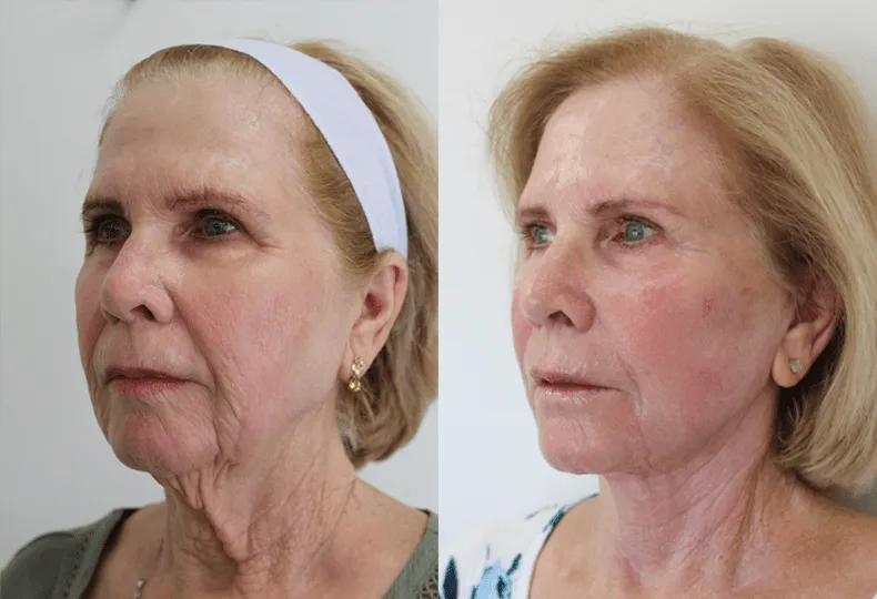Before and after facelift results on an older woman showcasing improved skin tightness and reduced wrinkles.
