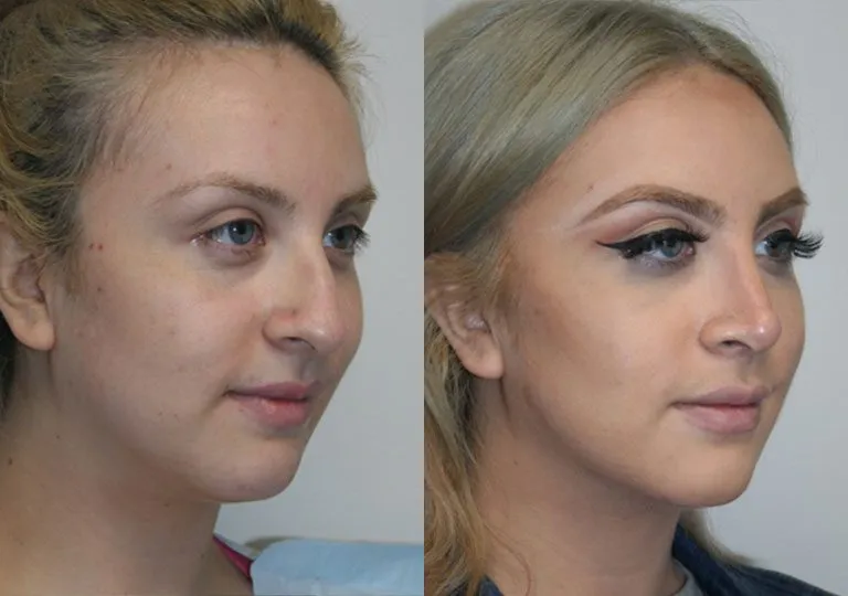 Before and after profile view of a woman's face post cosmetic surgery.