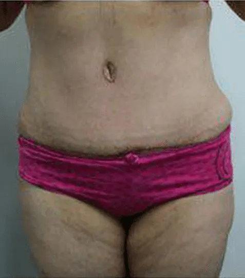 Enticing image of a woman's midsection pre-tummy tuck surgery, emphasizing smooth skin and contour improvements.