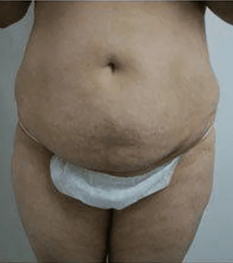 Midsection of a person before undergoing a tummy tuck procedure at a plastic surgery center.