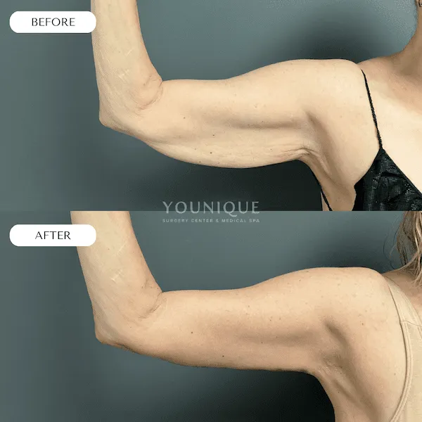 Before and after arm lift surgery, showcasing improved skin tightness and reduced sagging.