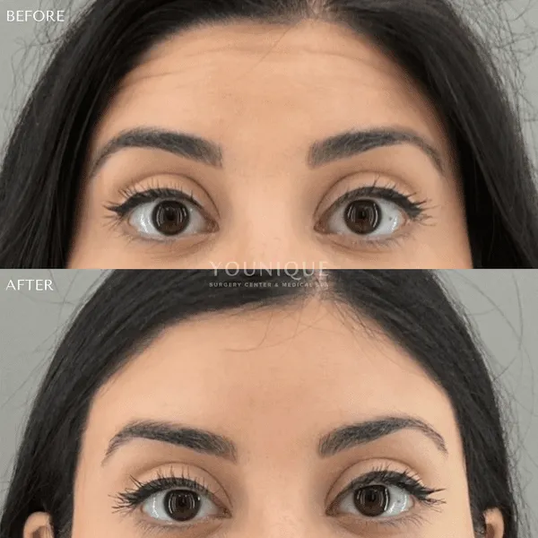 Before and after image of eyelid surgery results showing enhanced aesthetic appearance.