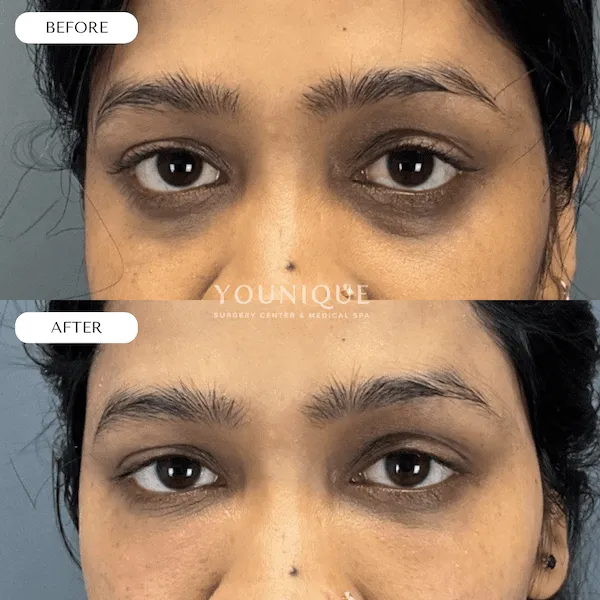 Before and after photo showing eye area enhancement at a plastic surgery center.
