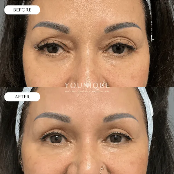 Before and after images of eyelid surgery showing improved appearance.