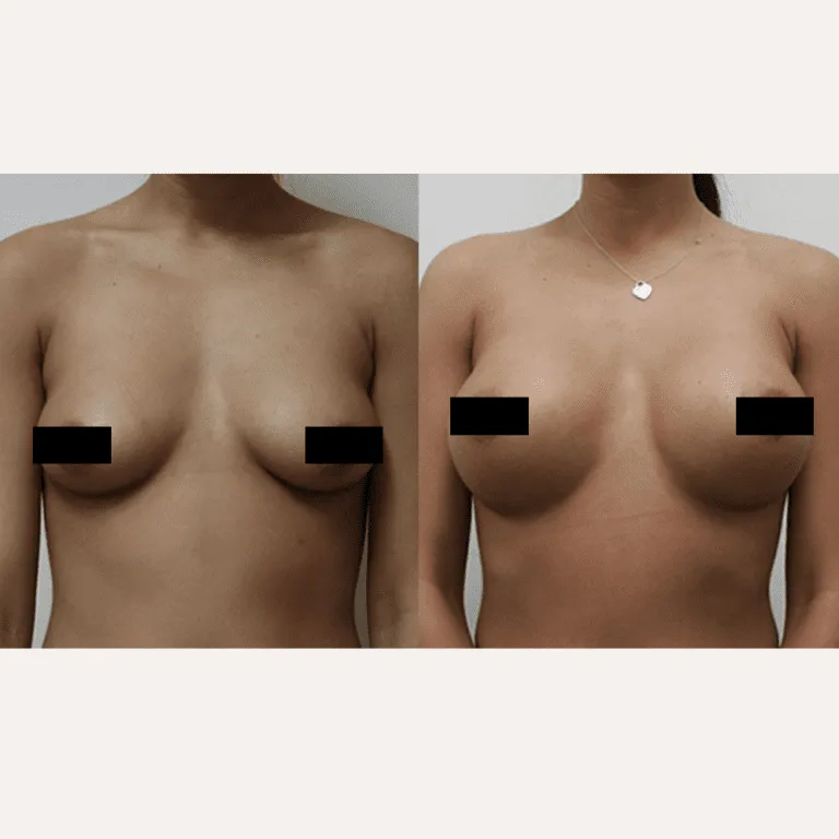 Before and after breast augmentation results showing enhanced symmetry and fullness.