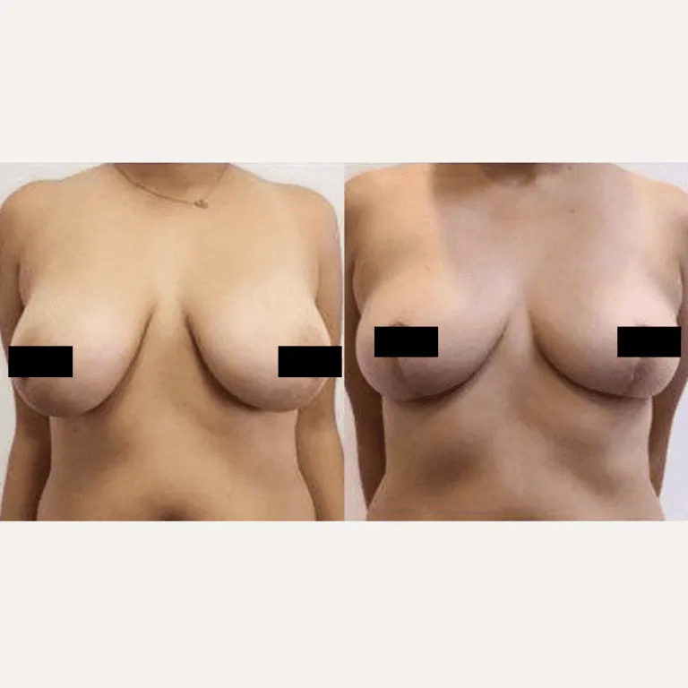 Before and after breast augmentation photos showing size and contour improvements.