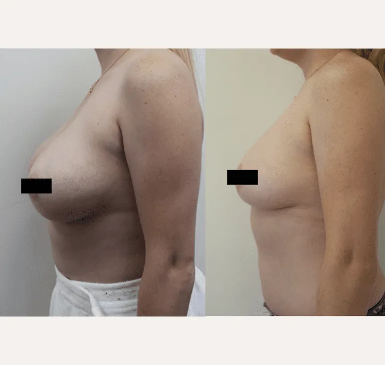 Before and after side profile of breast augmentation surgery.