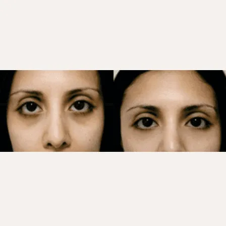 Before and after photos of upper blepharoplasty eye surgery.