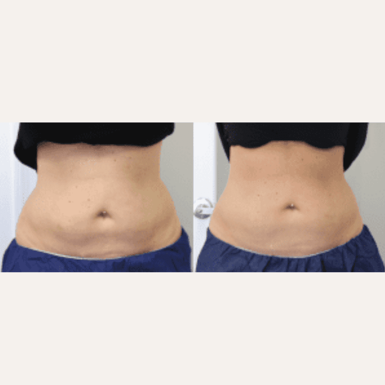Before and after image showing the results of a tummy tuck procedure.